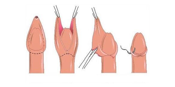 circoncision du prépuce pour augmenter la taille
